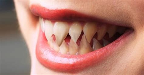 Sharpened Teeth