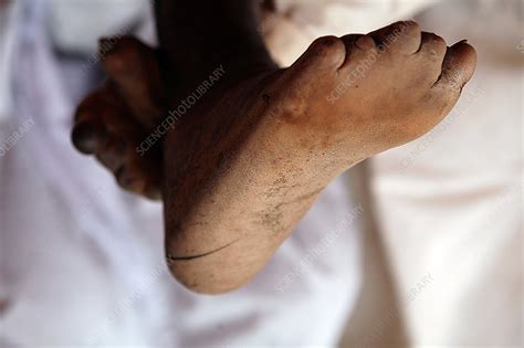 Leprosy - Stock Image - C053/0883 - Science Photo Library