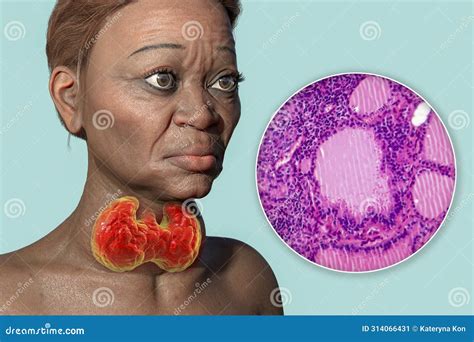 Toxic Goiter, 3D Illustration And Micrograph | CartoonDealer.com #302528511
