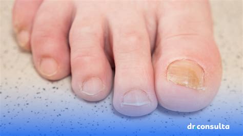 Unha Amarelada O Que Fazer - Fungo Nas Unhas Precoce Saiba O Que Fazer Para Evitar A Micose De Unha