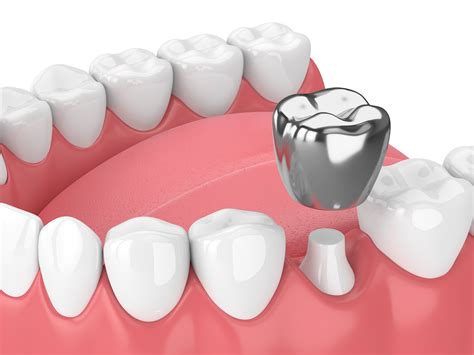dental crown coastal elegance tours