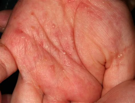 scabies pictures     symptoms  treatment