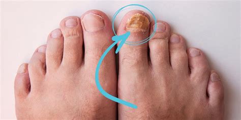 About us - Nail Fungus