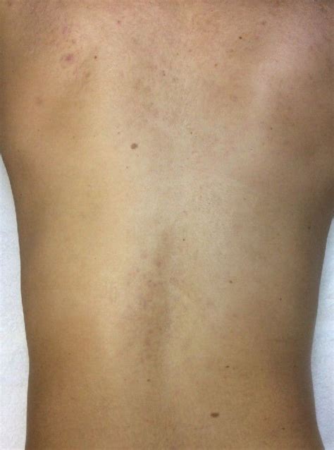 Acne & Scars treatment: laser for back acne | Perfect Aesthetics