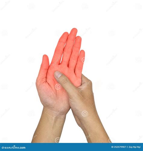 Hand Joints Inflammation. Concept Of Rheumatic Arthritis, Joint