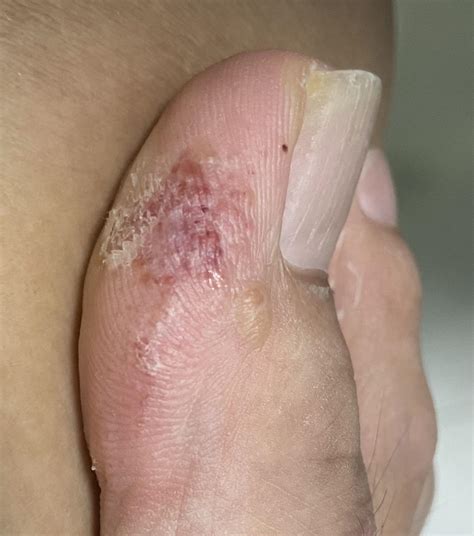 On my right toe, is it of concern? Didn’t know how it came about