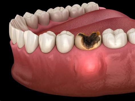 Why Do Teeth Randomly Hurt? Understanding the Causes and Remedies ...