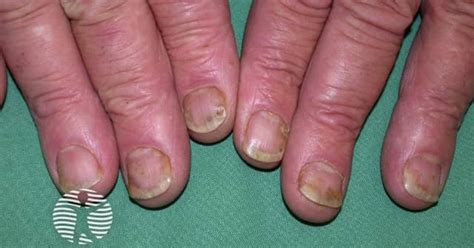 Nails in psoriasis image