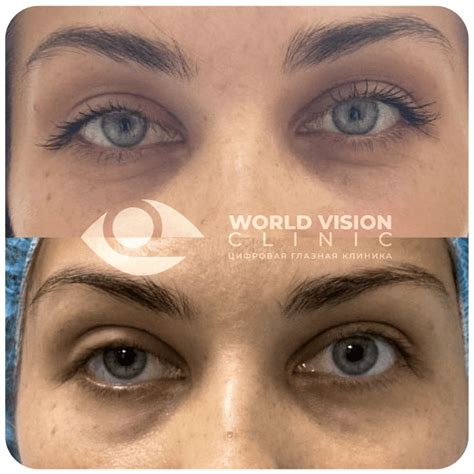 Круговая блефаропластика - World Vision Clinic