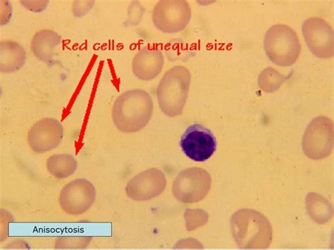 Anisocytosis