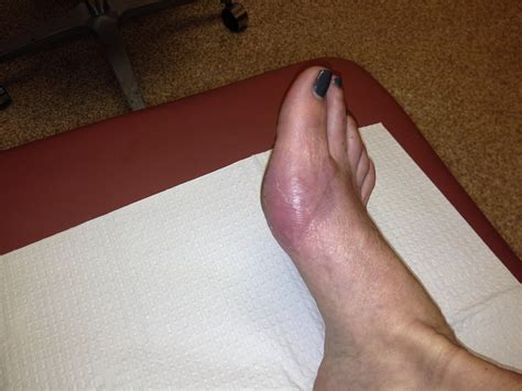 Sesamoidectomy Surgery.. My Journey (updated) – vanity, sanity and health