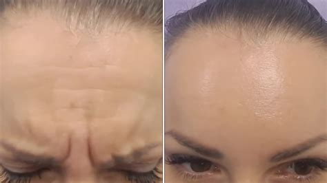 BOTOX- 400лв. в три зони-чело, гневна бръчка и бръчки тип”пачи крак ...