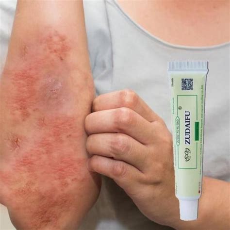 rash  common skin rashes pictures  treatment artofit