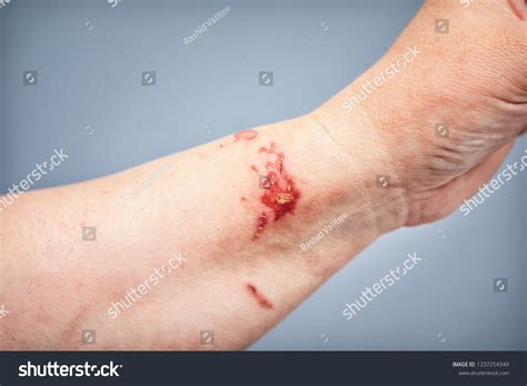 chemical burn  skin touching plant stock photo  shutterstock