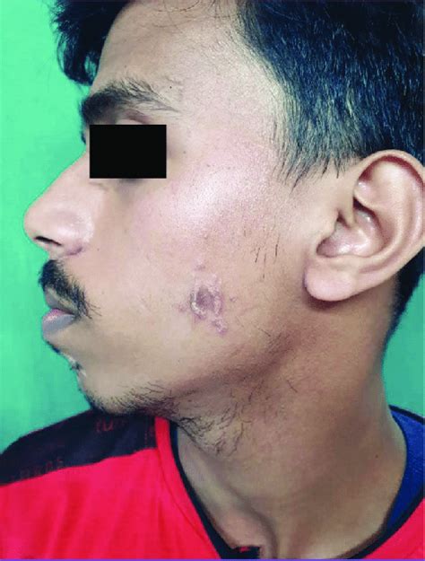 papular lesions  arranged  annular configuration  left sided