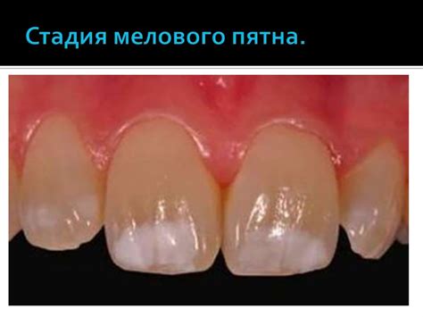 Стадии кариеса: меловое пятно, пигментированное, поверхностный кариес ...
