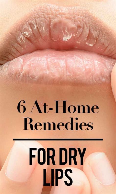 At-Home Remedies For Dry Lips | Remedies For Chapped Lips | Dry skin ...