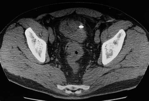 Абсцесс сигмовидной кишки — 24Radiology.ru