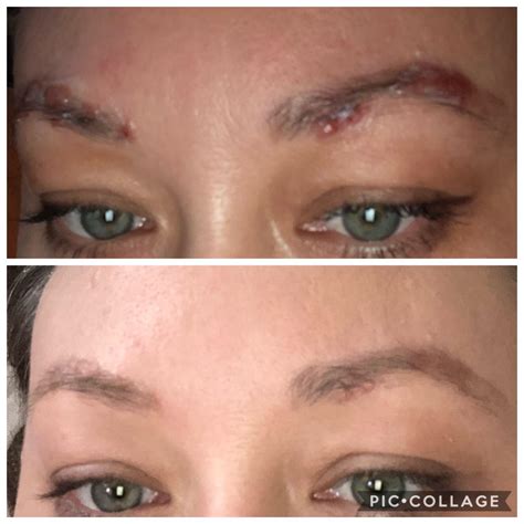 Skin improvement after only four days of treatment. : r/sarcoidosis