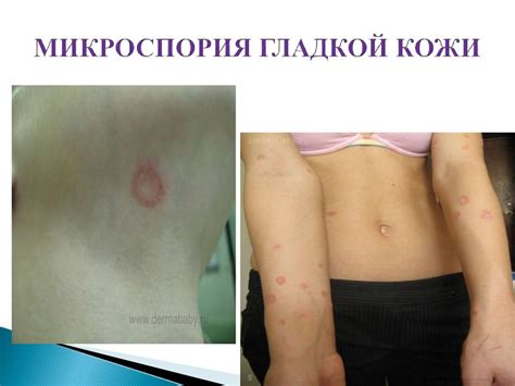 Заболевания кожи - online presentation