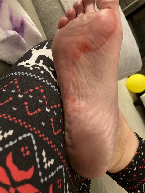 Is this some kind of bug bite? : r/DiagnoseMe