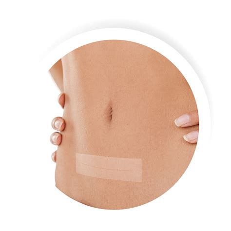 Prevention of Scars | Scar Treatment Silicone Sheets - The Marena Group ...
