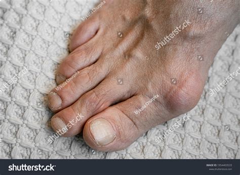 swelling joints toes painful gout inflammation stock photo