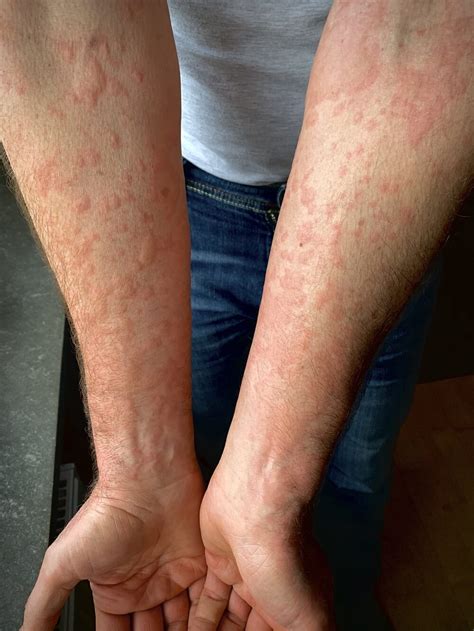 Can’t-Miss Takeaways Of Tips About How To Prevent Hives - Delaybeat