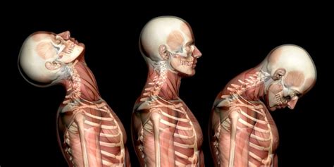 Whiplash and How to Treat it – Movement and Wellbeing Clinic