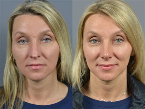 Nose Surgery Before & After Patient 16 | Dr. Marotta