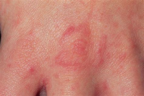 Scatol mot skabb - Effekt, bivirkninger, bestill resept