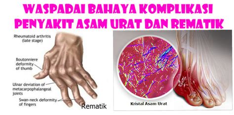 gejala rematik   terjadi setelah  melakukan