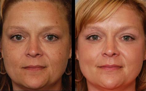 ALL NEW! BBL & Moxi Forever Young Laser at your #1 Medspa Body BeneFits!
