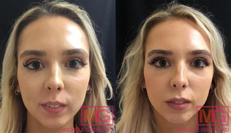 Juvederm Ultra Before And After Lips | Lipstutorial.org