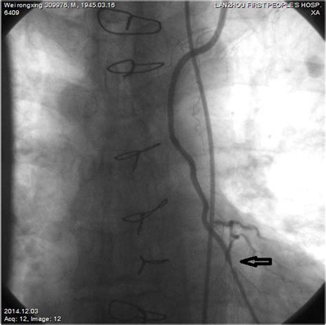 Four case reports of left anterior descending restenosis treated via ...