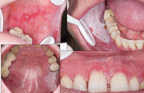 oral lichen planus  related lesions    accept based