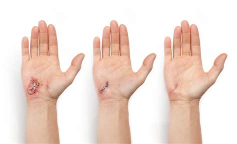 Understanding Poorly Healing Wounds: Causes, Symptoms, And The ...