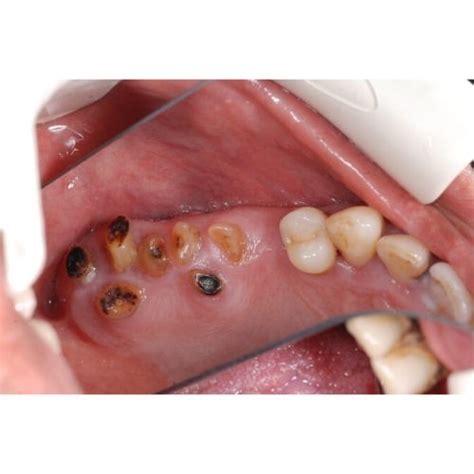 Trypophobia Teeth