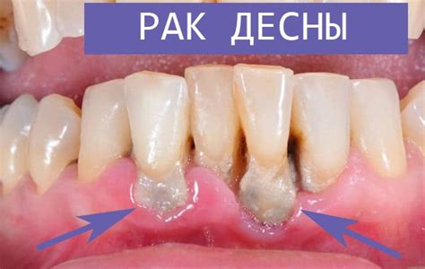 Рак десны, начальная стадия: фото, симптомы, лечение