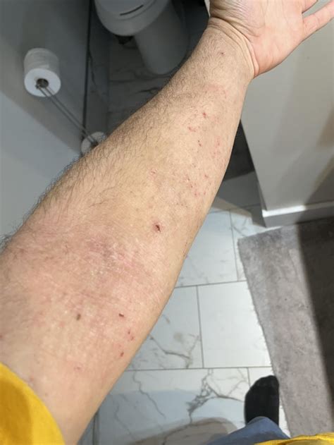 Arms update 3 days later : r/eczema