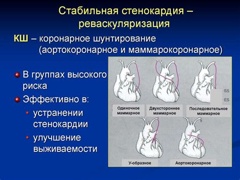 ИБС. Стенокардия - презентация онлайн