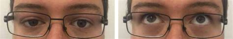 Ocular Manifestations of Miller Fisher Syndrome: a Case Report ...