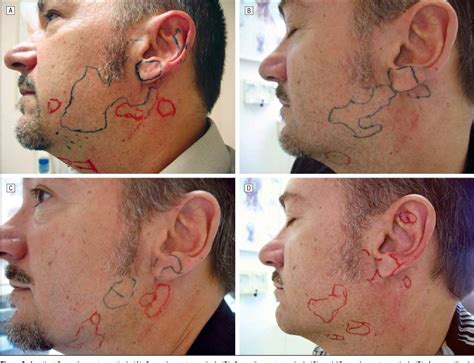 Greater Auricular Nerve Block