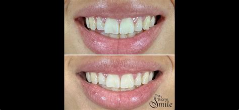 teeth reshaping  warm smile