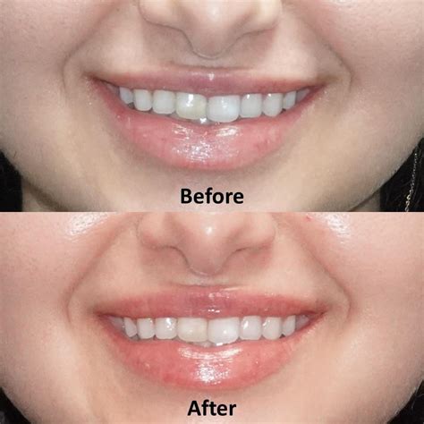 Lip Flip Botox Before And After Photos - Infoupdate.org