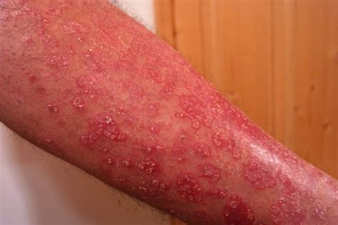 Stres i psorijaza