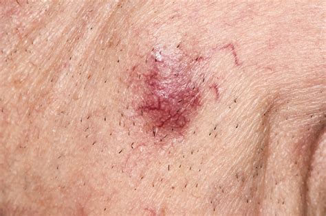 merkel cell carcinoma stage  strong predictor  recurrence risk