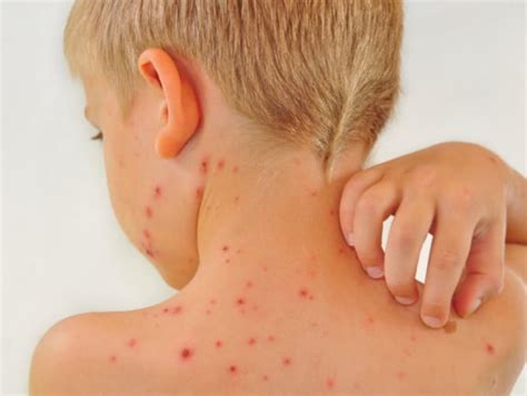 Skin Rashes In Child Pictures Photos - vrogue.co