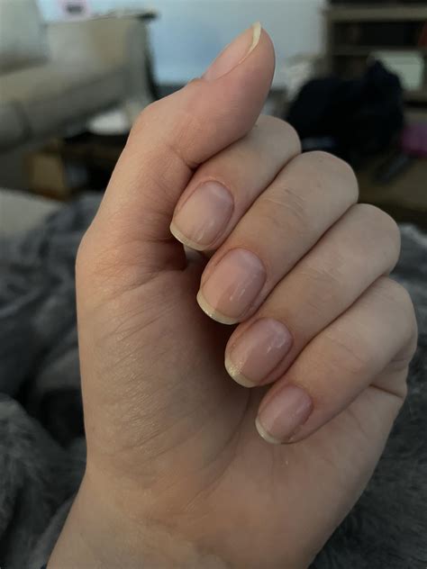 Should I be concerned about bump on my nail? I first got these bumps