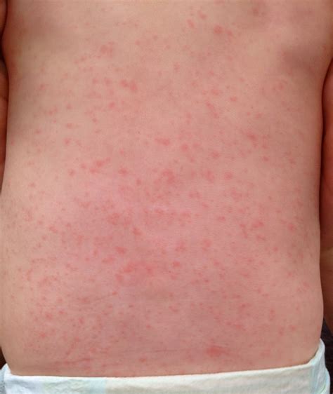 Skin Rashes On Toddlers